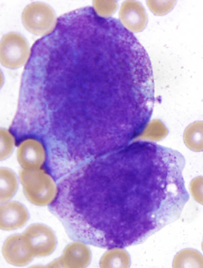 Fig 1F BMA atypical promyelocyte 3